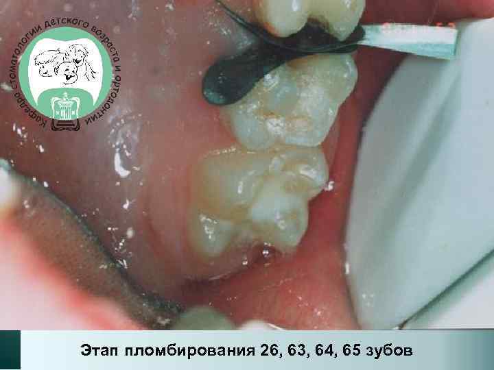 Этап пломбирования 26, 63, 64, 65 зубов 