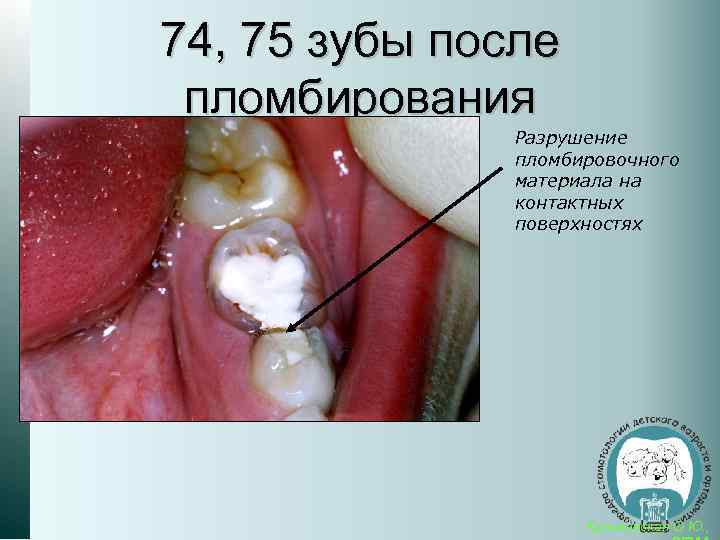 74, 75 зубы после пломбирования Разрушение пломбировочного материала на контактных поверхностях Кузьминская О. Ю.