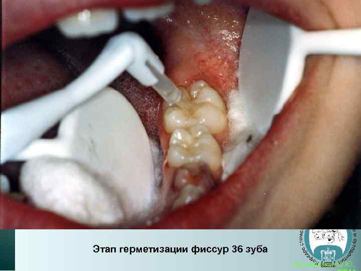 Этап герметизации фиссур 36 зуба Кузьминская О. Ю. , 