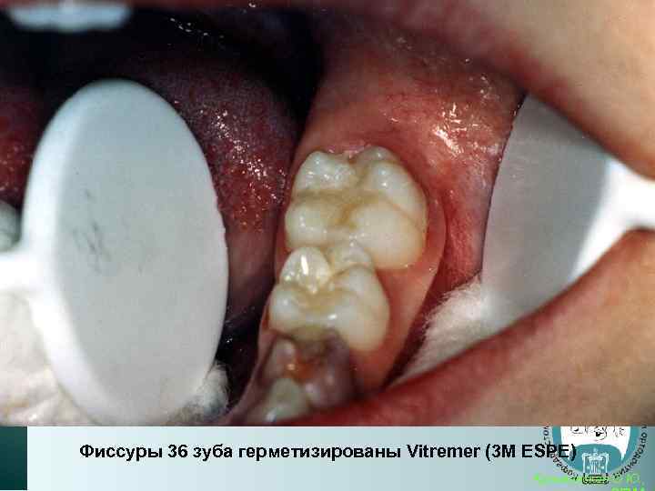 Фиссуры 36 зуба герметизированы Vitremer (3 M ESPE) Кузьминская О. Ю. , 