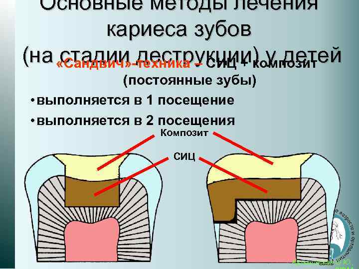 Основные методы лечения кариеса зубов (на «Сандвич» -техника – СИЦ + композит стадии деструкции)