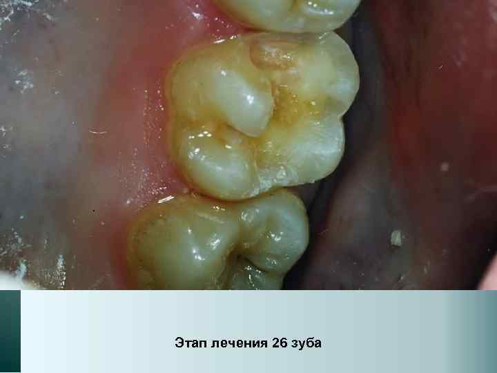 Этап лечения 26 зуба 