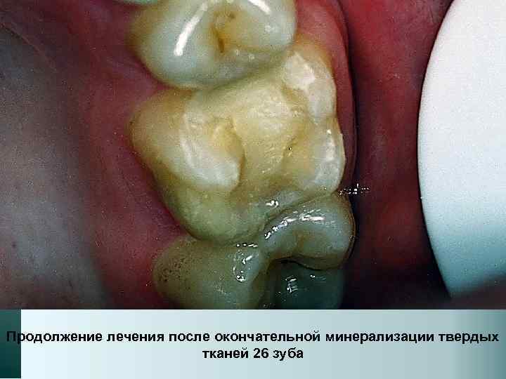 Продолжение лечения после окончательной минерализации твердых тканей 26 зуба 