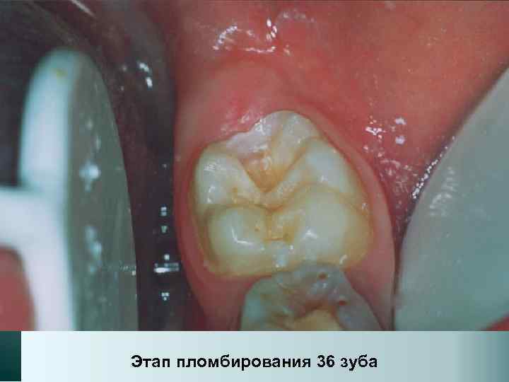 Этап пломбирования 36 зуба 