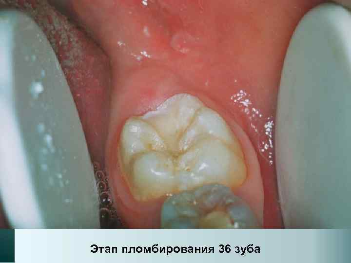 Этап пломбирования 36 зуба 