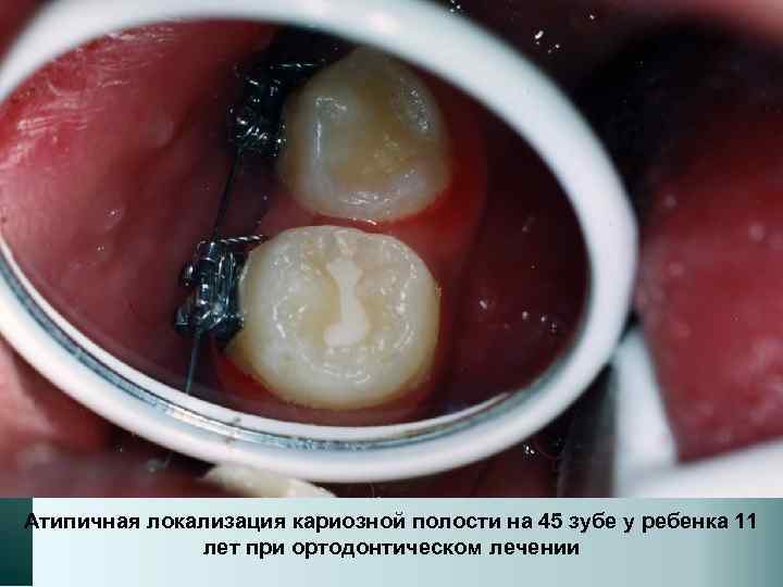 Атипичная локализация кариозной полости на 45 зубе у ребенка 11 лет при ортодонтическом лечении