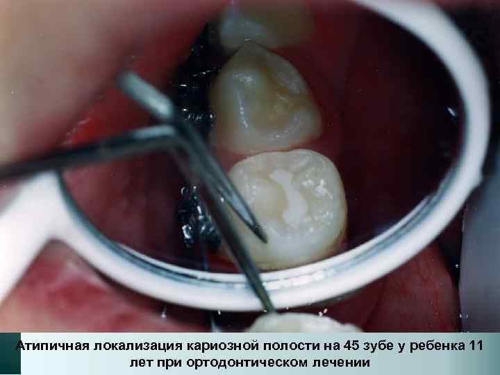 Атипичная локализация кариозной полости на 45 зубе у ребенка 11 лет при ортодонтическом лечении