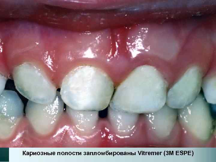 Кариозные полости запломбированы Vitremer (3 M ESPE) 