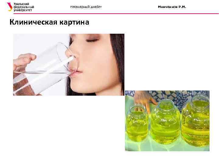    Несахарный диабет  Минченков Р. М. Клиническая картина 