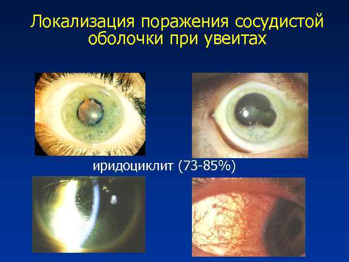 Локализация поражения сосудистой оболочки при увеитах иридоциклит (73 -85%) 