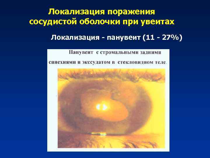 Локализация поражения сосудистой оболочки при увеитах Локализация - панувеит (11 - 27%) 