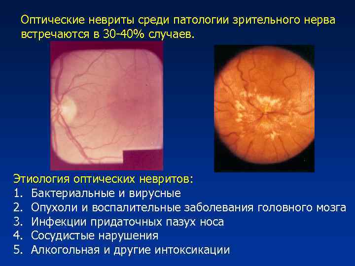 Оптические невриты среди патологии зрительного нерва встречаются в 30 -40% случаев. Этиология оптических невритов: