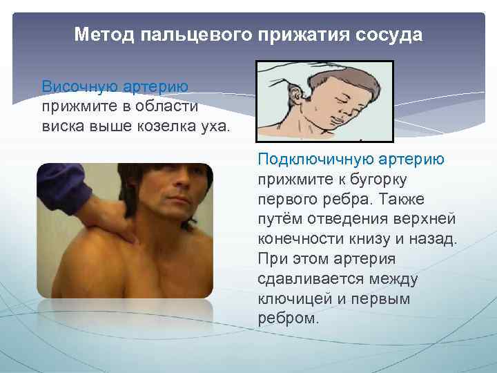 Метод пальцевого прижатия сосуда Височную артерию прижмите в области виска выше козелка уха. Подключичную