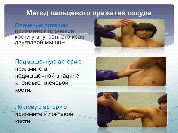 Метод пальцевого прижатия сосуда Плечевую артерию прижмите к плечевой кости у внутреннего края двуглавой