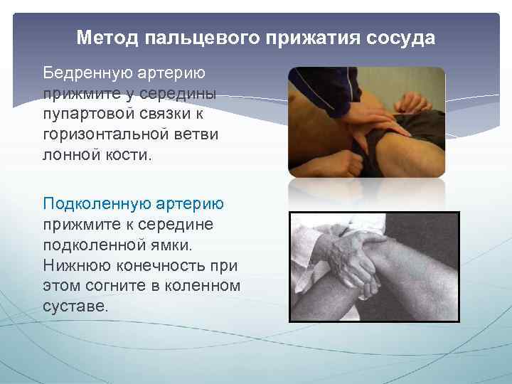 Метод пальцевого прижатия сосуда Бедренную артерию прижмите у середины пупартовой связки к горизонтальной ветви