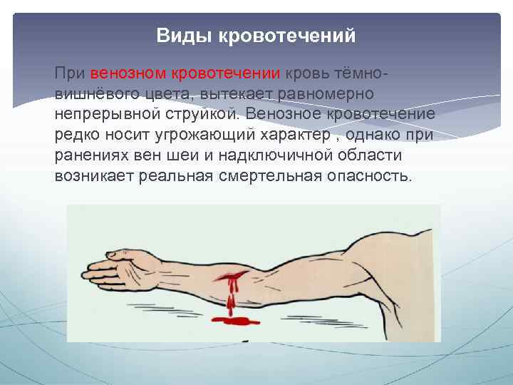 Виды кровотечений При венозном кровотечении кровь тёмновишнёвого цвета, вытекает равномерно непрерывной струйкой. Венозное кровотечение