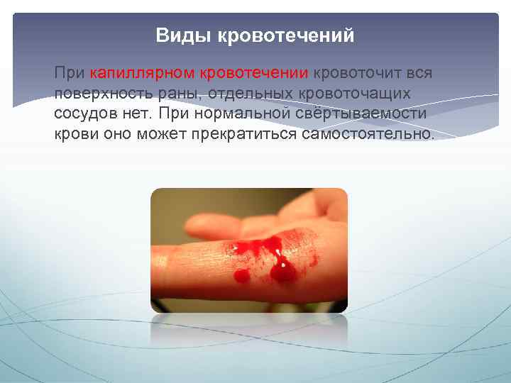 Виды кровотечений При капиллярном кровотечении кровоточит вся поверхность раны, отдельных кровоточащих сосудов нет. При