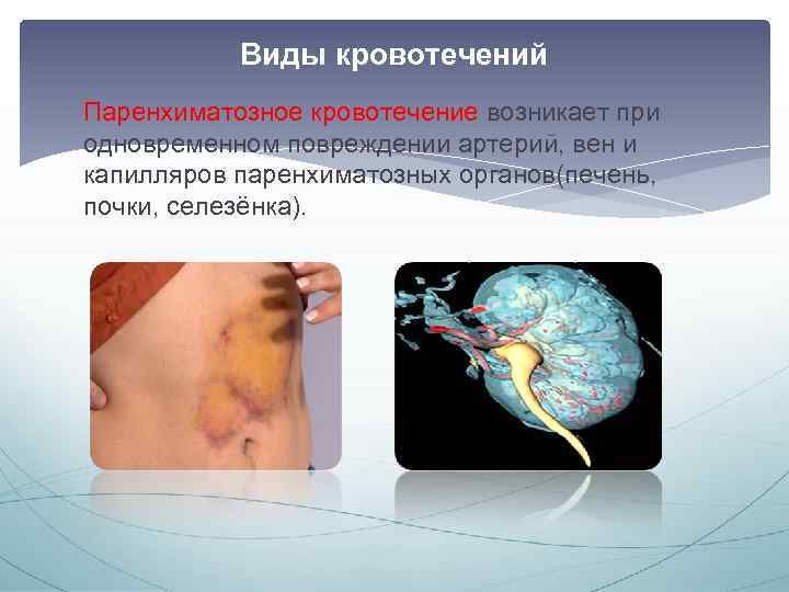 Виды кровотечений Паренхиматозное кровотечение возникает при одновременном повреждении артерий, вен и капилляров паренхиматозных органов(печень,