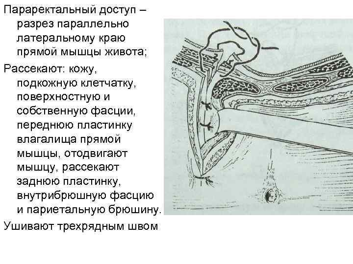 Параректальный доступ – разрез параллельно латеральному краю прямой мышцы живота; Рассекают: кожу, подкожную клетчатку,