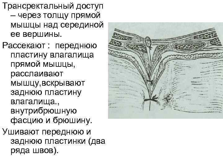 Трансректальный доступ – через толщу прямой мышцы над серединой ее вершины. Рассекают : переднюю