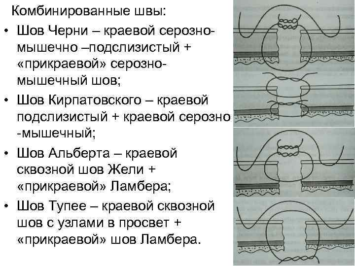  Комбинированные швы: • Шов Черни – краевой серозно- мышечно –подслизистый + «прикраевой» серозно-