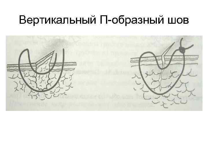 Вертикальный П-образный шов 