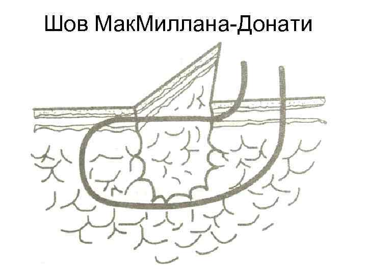 Шов Мак. Миллана-Донати 