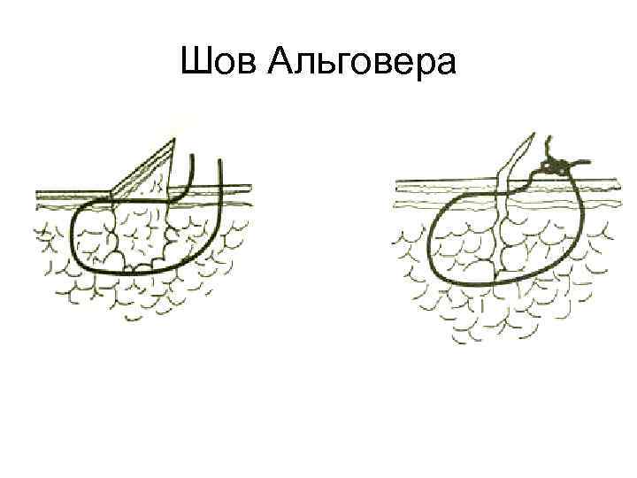 Шов Альговера 