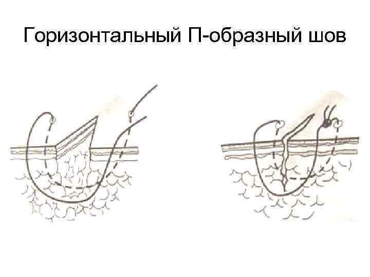 Горизонтальный П-образный шов 