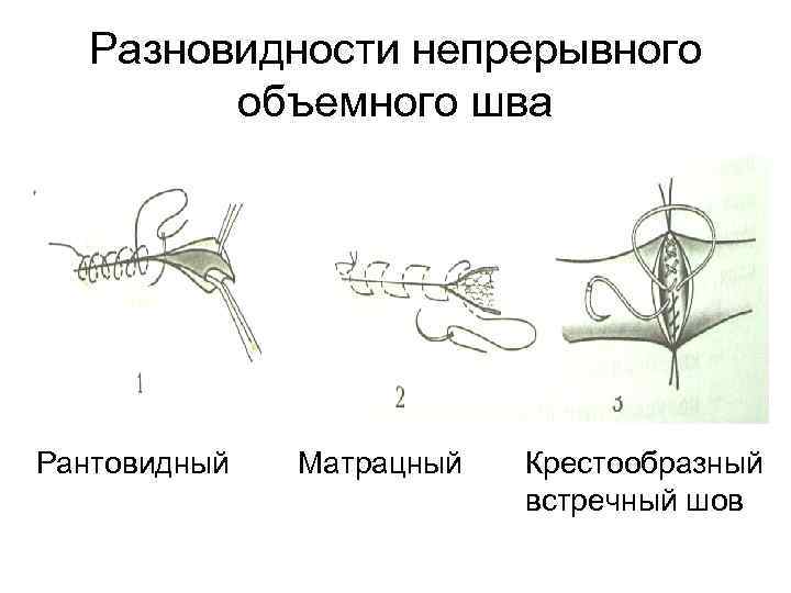  Разновидности непрерывного объемного шва Рантовидный Матрацный Крестообразный встречный шов 