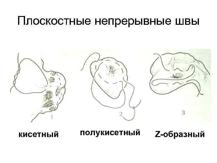 Плоскостные непрерывные швы кисетный полукисетный Z-образный 