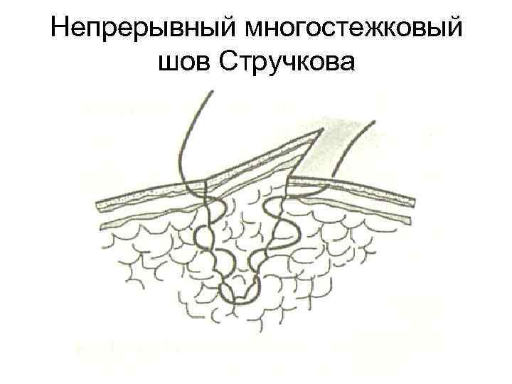 Непрерывный многостежковый шов Стручкова 