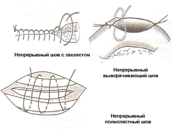 Непрерывный шов с захлестом Непрерывный выворачивающий шов Непрерывный полиспастный шов 