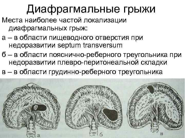  Диафрагмальные грыжи Места наиболее частой локализации диафрагмальных грыж: а – в области пищеводного