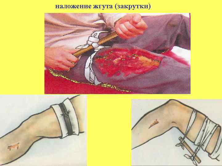  наложение жгута (закрутки) 