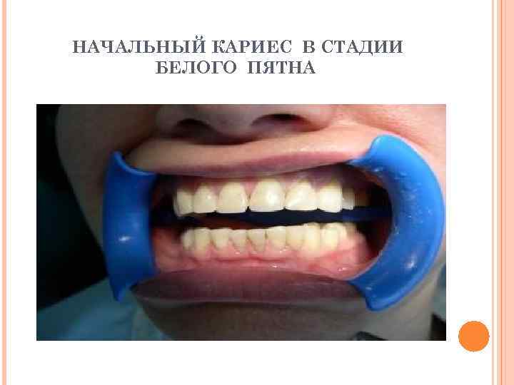 НАЧАЛЬНЫЙ КАРИЕС В СТАДИИ БЕЛОГО ПЯТНА 