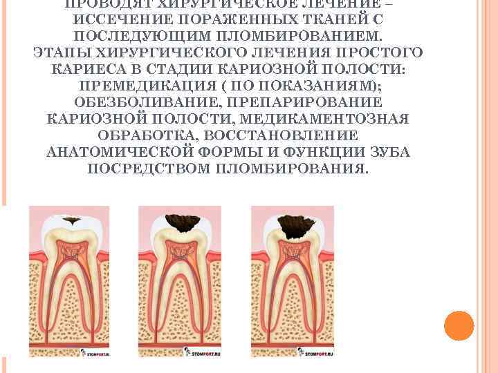 ПРОВОДЯТ ХИРУРГИЧЕСКОЕ ЛЕЧЕНИЕ – ИССЕЧЕНИЕ ПОРАЖЕННЫХ ТКАНЕЙ С ПОСЛЕДУЮЩИМ ПЛОМБИРОВАНИЕМ. ЭТАПЫ ХИРУРГИЧЕСКОГО ЛЕЧЕНИЯ ПРОСТОГО