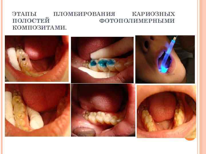 ЭТАПЫ ПЛОМБИРОВАНИЯ КАРИОЗНЫХ ПОЛОСТЕЙ ФОТОПОЛИМЕРНЫМИ КОМПОЗИТАМИ. 