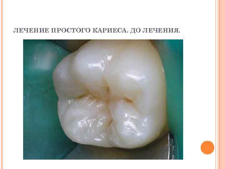ЛЕЧЕНИЕ ПРОСТОГО КАРИЕСА. ДО ЛЕЧЕНИЯ. 