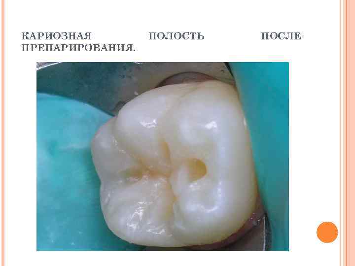 КАРИОЗНАЯ ПРЕПАРИРОВАНИЯ. ПОЛОСТЬ ПОСЛЕ 