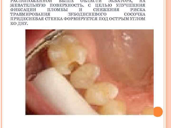 РАСПОЛОЖЕННОЙ ВЫШЕ ОБЛАСТИ ЭКВАТОРА, НА ЖЕВАТЕЛЬНУЮ ПОВЕРХНОСТЬ. С ЦЕЛЬЮ УЛУЧШЕНИЯ ФИКСАЦИИ ПЛОМБЫ И СНИЖЕНИЯ