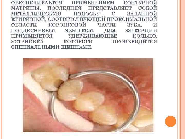 ОБЕСПЕЧИВАЕТСЯ ПРИМЕНЕНИЕМ КОНТУРНОЙ МАТРИЦЫ. ПОСЛЕДНЯЯ ПРЕДСТАВЛЯЕТ СОБОЙ МЕТАЛЛИЧЕСКУЮ ПОЛОСКУ С ЗАДАННОЙ КРИВИЗНОЙ, СООТВЕТСТВУЮЩЕЙ ПРОКСИМАЛЬНОЙ