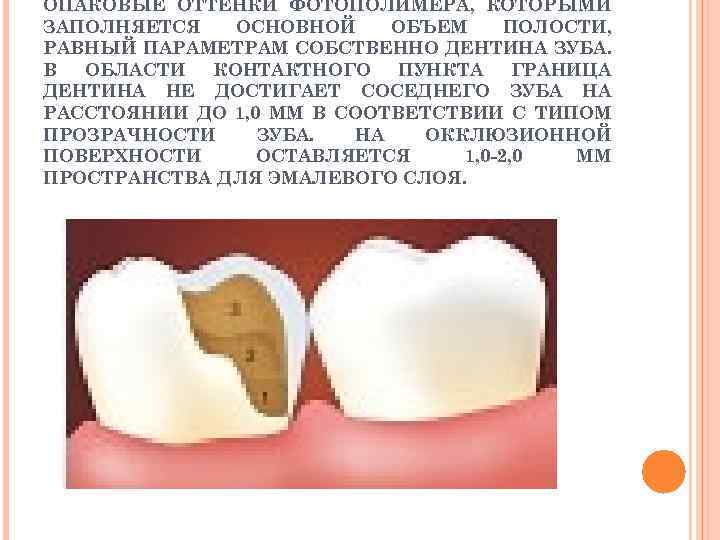 ОПАКОВЫЕ ОТТЕНКИ ФОТОПОЛИМЕРА, КОТОРЫМИ ЗАПОЛНЯЕТСЯ ОСНОВНОЙ ОБЪЕМ ПОЛОСТИ, РАВНЫЙ ПАРАМЕТРАМ СОБСТВЕННО ДЕНТИНА ЗУБА. В