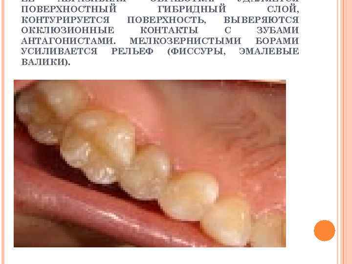 ЕЕ АБРАЗИВНАЯ ОБРАБОТКА: УДАЛЯЕТСЯ ПОВЕРХНОСТНЫЙ ГИБРИДНЫЙ СЛОЙ, КОНТУРИРУЕТСЯ ПОВЕРХНОСТЬ, ВЫВЕРЯЮТСЯ ОККЛЮЗИОННЫЕ КОНТАКТЫ С ЗУБАМИ