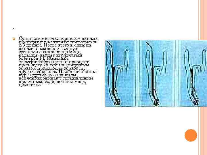 . Сущность метода: корневые каналы проходят и расширяют примерно на 2/3 длины. После этого