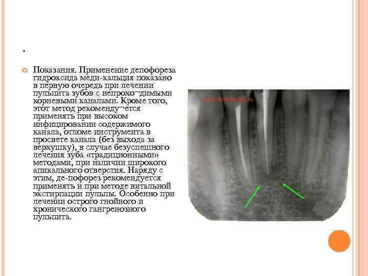 . Показания. Применение депофореза гидроксида меди-кальция показано в первую очередь при лечении пульпита зубов