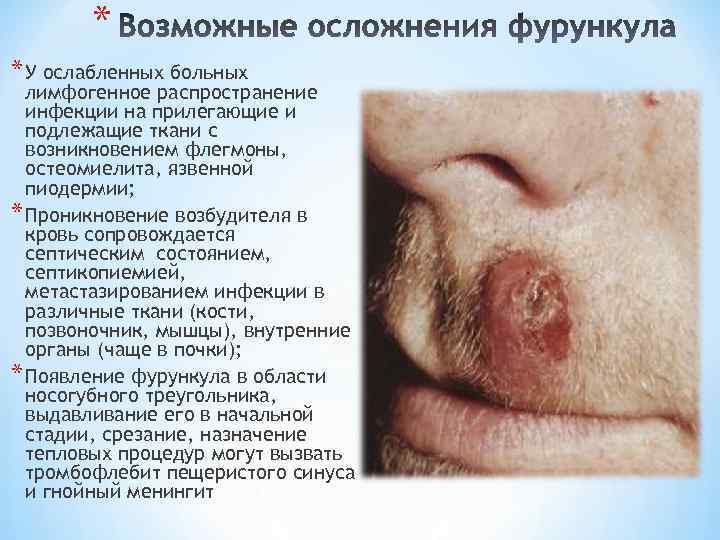 * * У ослабленных больных лимфогенное распространение инфекции на прилегающие и подлежащие ткани с