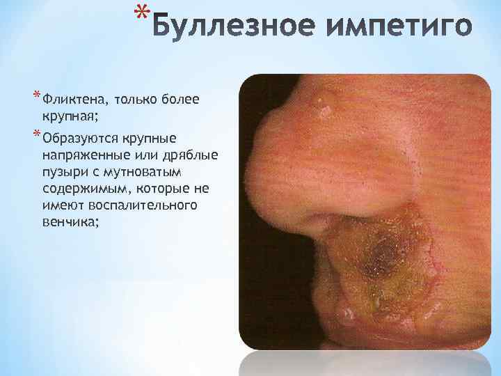 * * Фликтена, только более крупная; * Образуются крупные напряженные или дряблые пузыри с