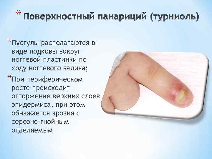 * *Пустулы располагаются в виде подковы вокруг ногтевой пластинки по ходу ногтевого валика; *При
