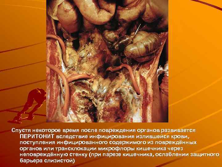 Спустя некоторое время после повреждения органов развивается ПЕРИТОНИТ вследствие инфицирования излившейся крови, поступления инфицированного
